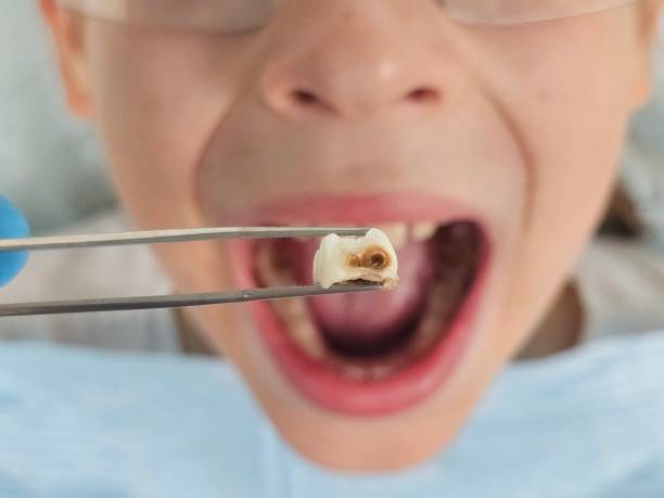 Best Emergency Treatment for Dental Infections or Abscesses in Morton, PA
